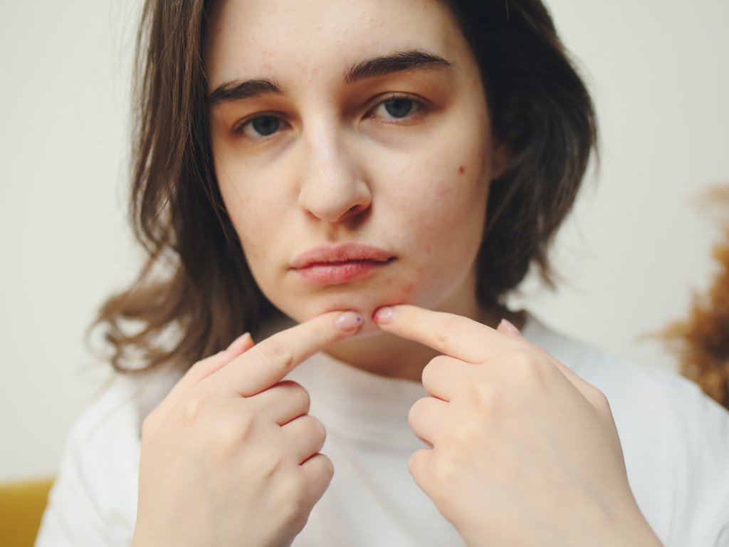 Jak poradzić sobie z trądzikiem? Skuteczne oczyszczanie twarzy